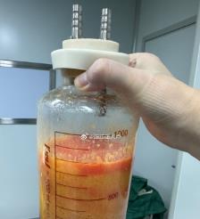 邳州水动力吸脂手术要做多久？